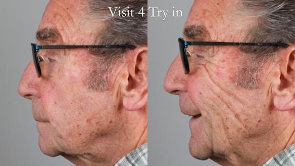 Newsletter 50 Special edition Complete Dentures FULL PROTOCOL