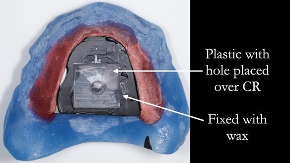 Finlay's Newsletter 62 provision of extractions and metal based complete dentures for Rafique