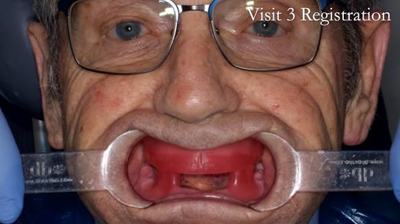 Newsletter 50 Special edition Complete Dentures FULL PROTOCOL