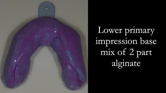 Finlay's Case Study Newsletter 40 - Immediate Mk 1 RPD to Definitive Mk 2 RPD - full protocol