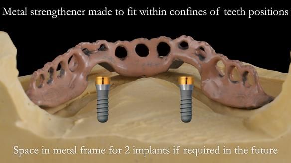 Newsletter 50 Special edition Complete Dentures FULL PROTOCOL