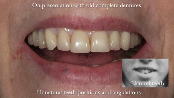 Newsletter 75: Marion’s case - Step-by-step complete denture workflow
