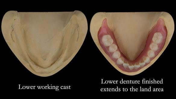 Newsletter 75: Marion’s case - Step-by-step complete denture workflow