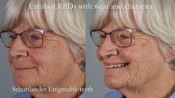 Eileen's transformation with upper and lower RPDs of Scandinavian hygienic design FULL PROTOCOL