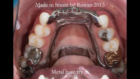 Newsletter 66 Long term case study. Life changing metal based RPD made for Anna