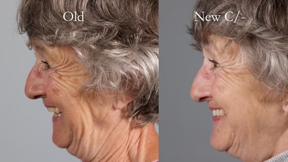 Solving Linda’s Failed “All on 4” implant bridges - full protocol Newsletter 42