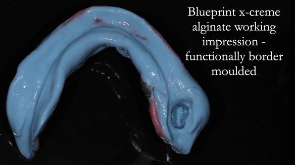 Finlay's Newsletter 59 Ultra hard partial dentures made for Gill