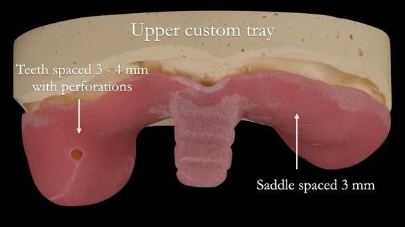 Newsletter 52 Managing Jo’s failing dentition with extractions and Mk 1/Mk 2 complete upper dentures and lower partial dentures FULL PROTOCOL