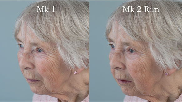 Figure 75 Comparison of Mk 1 denture and Mk 2 rim - improved lip support