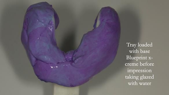 Newsletter 75: Marion’s case - Step-by-step complete denture workflow