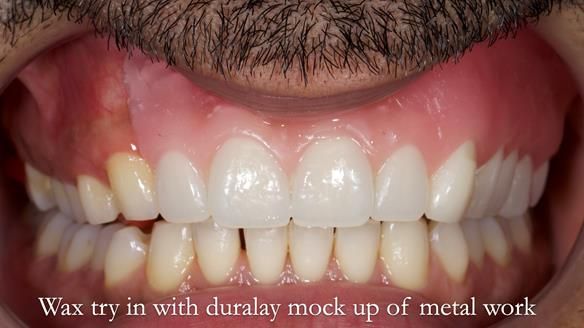 Upper metal base partial denture/occlusal stabilisation splint/obturator - full protocol