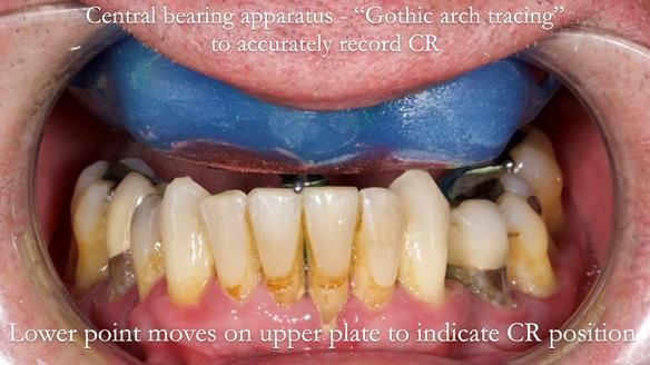 Newsletter 77: Jeremy’s case – immediate complete upper denture