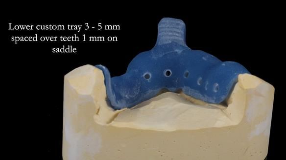 Newsletter 55 Provision of metal based partial dentures for Zephyrine with a repaired cleft lip and palate