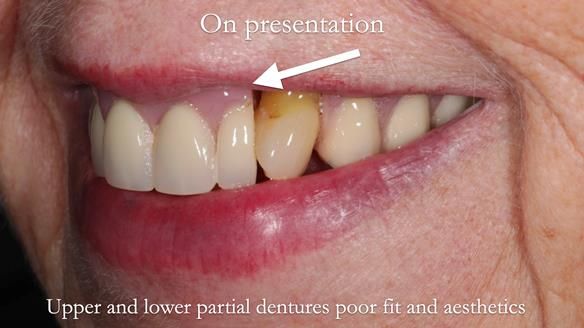 Finlay's Newsletter 59 Ultra hard partial dentures made for Gill
