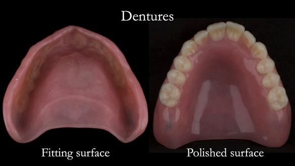 Newsletter 75: Marion’s case - Step-by-step complete denture workflow