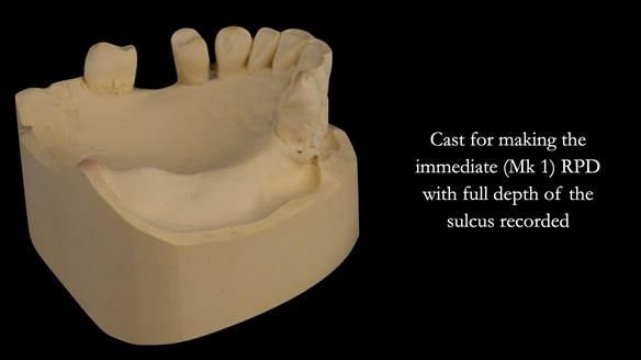 Finlay's Case Study Newsletter 40 - Immediate Mk 1 RPD to Definitive Mk 2 RPD - full protocol
