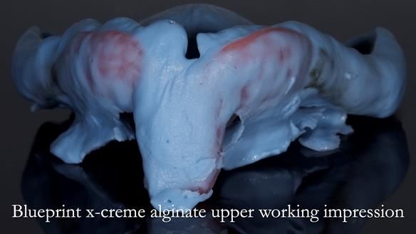 Newsletter 54 case presentation upper complete denture and lower Scandinavian designed hygienic partial denture for David