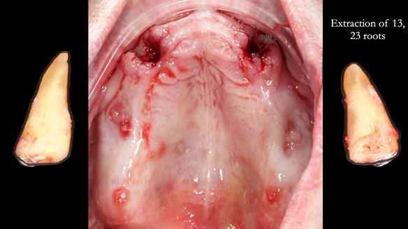 Newsletter 77: Jeremy’s case – immediate complete upper denture