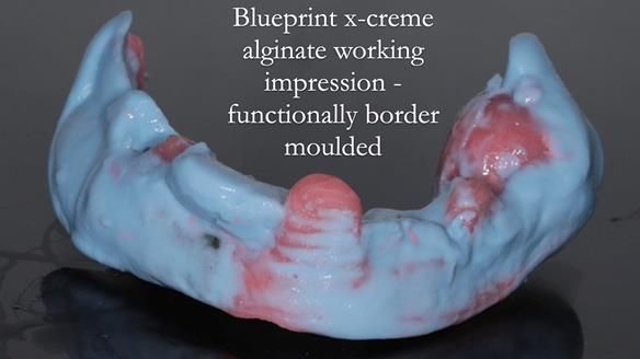 Finlay's Newsletter 59 Ultra hard partial dentures made for Gill