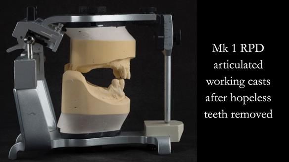 Finlay's Case Study Newsletter 40 - Immediate Mk 1 RPD to Definitive Mk 2 RPD - full protocol