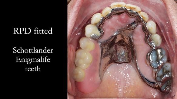 Finlay's Newsletter 64 case study - provision of a Kennedy class 2 metal based Scandinavian RPD for Ian