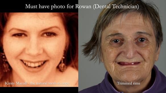 Newsletter 83: Sheila’s Complete Denture Success