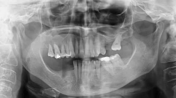Finlay's Newsletter 61 provision of a lower unilateral free end saddle metal based partial denture for Joyce