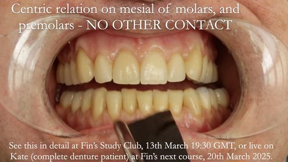 Newsletter 75: Marion’s case - Step-by-step complete denture workflow