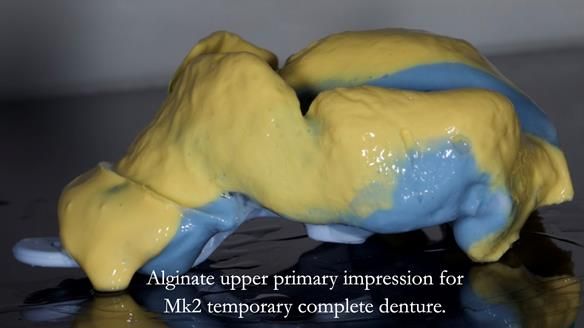 Newsletter 77: Jeremy’s case – immediate complete upper denture
