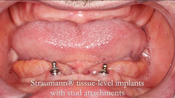 Newsletter 78: What do Clark Gable and a Locator® overdenture have in common?