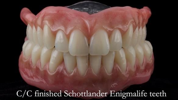 Managing poor implant positioning with complete dentures and Locator attachments - full protocol Newsletter 41