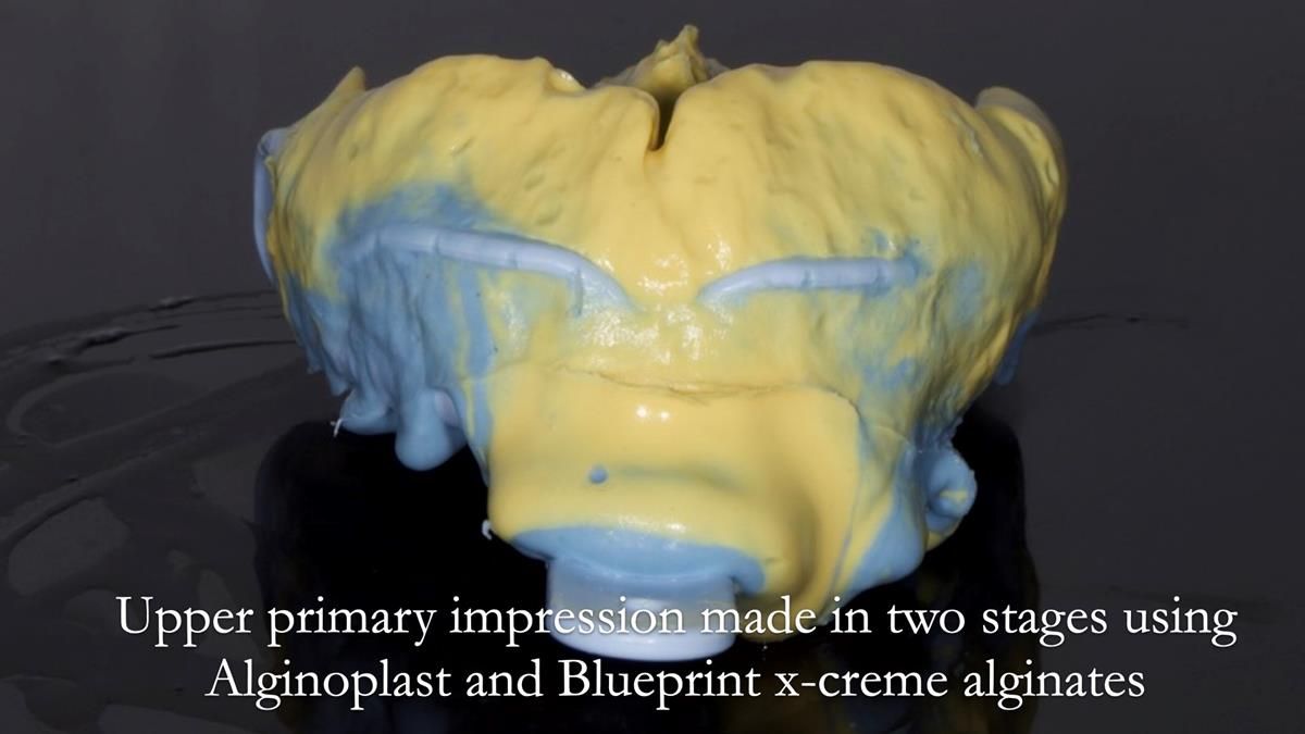 Newsletter 89 – Simon: A Challenging Kennedy Class II Division 1 Upper CoCr Partial Denture with a High Smile Line