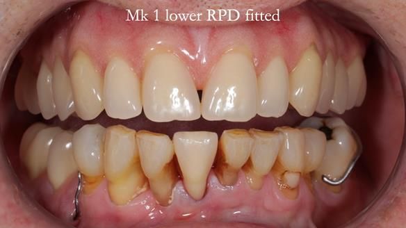 Newsletter 54 case presentation upper complete denture and lower Scandinavian designed hygienic partial denture for David