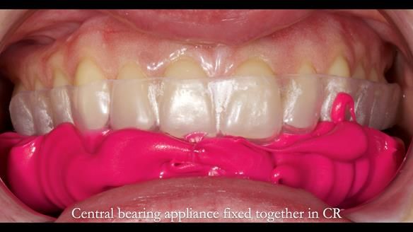 Newsletter 82 Mary - A complete upper and a one-tooth gasket denture