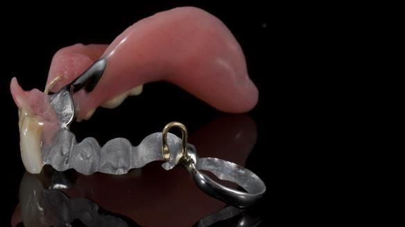 Newsletter 86 Peter the Architect — precision removable partial dentures case study