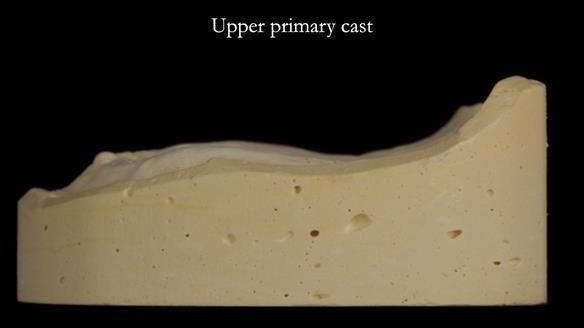 Newsletter 83: Sheila’s Complete Denture Success