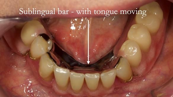 Finlay's Case Study Newsletter 40 - Immediate Mk 1 RPD to Definitive Mk 2 RPD - full protocol