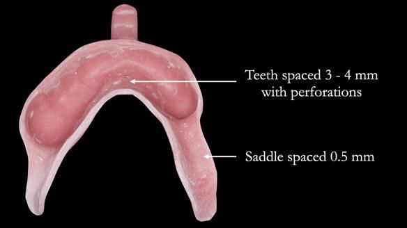 Newsletter 52 Managing Jo’s failing dentition with extractions and Mk 1/Mk 2 complete upper dentures and lower partial dentures FULL PROTOCOL