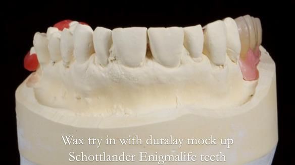 Finlay's Newsletter 64 case study - provision of a Kennedy class 2 metal based Scandinavian RPD for Ian