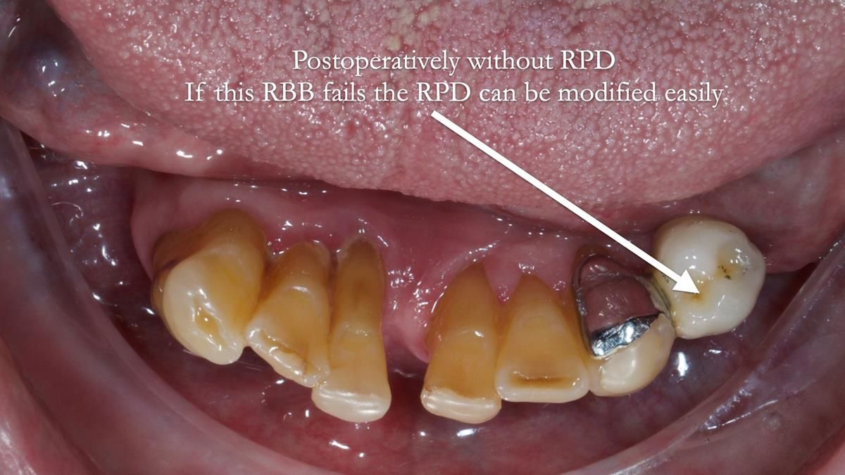 Newsletter 87 – Father Peter: A Partial Denture that needed Minor Miracle