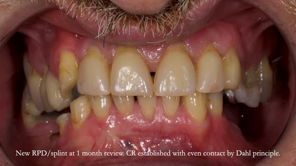 How Keith’s combat denture transformed his life – Newsletter 73