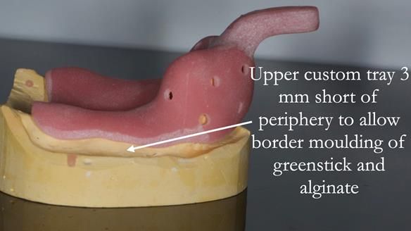 Finlay's Case Study Newsletter 40 - Immediate Mk 1 RPD to Definitive Mk 2 RPD - full protocol