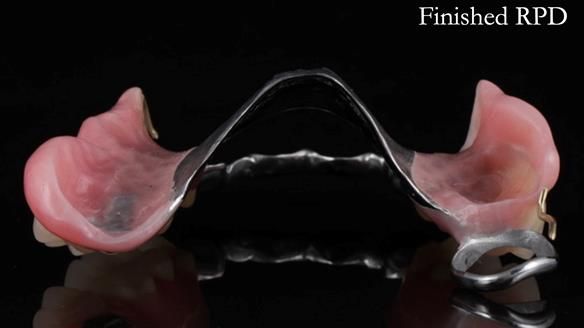 Finlay's Newsletter 60 Sylvia's upper Kennedy Class 2 Mod 1 metal based upper RPD