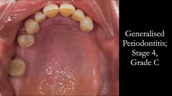 Finlay's Case Study Newsletter 40 - Immediate Mk 1 RPD to Definitive Mk 2 RPD - full protocol