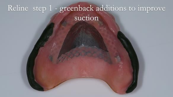Newsletter 54 case presentation upper complete denture and lower Scandinavian designed hygienic partial denture for David