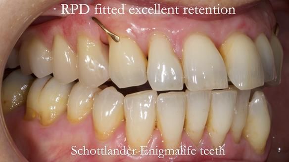 Newsletter 56 showing the making and fitting of a bilateral free end saddle upper removable partial denture (RPD) for patient with pemphigus