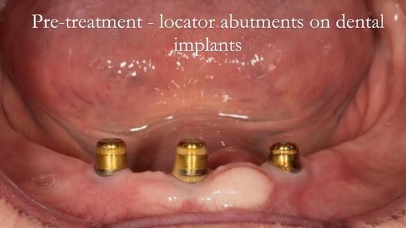 Pre-treatment. Locator abutments on dental implants. Calculus present. Scaling and oral hygiene instruction given.