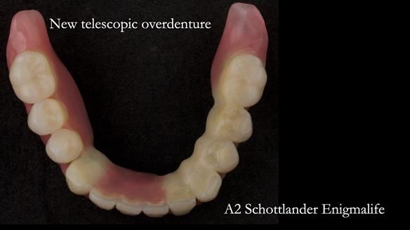Newsletter 76: Jackie’s case – Telescopic overdenture & precision RPD (the tricky truth!)