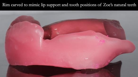 Finlay's Newsletter 58 Gasket upper partial denture for Zoe
