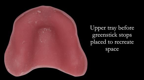 Finlay's Newsletter 62 provision of extractions and metal based complete dentures for Rafique